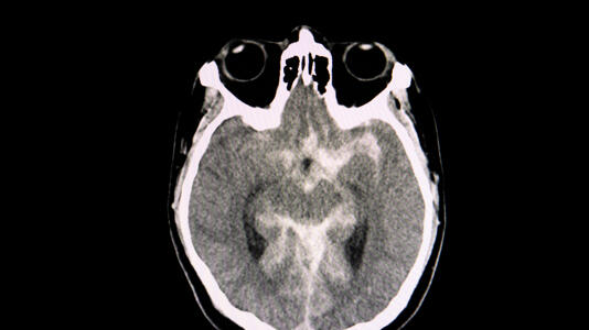 Radiologen & KI scheitern oft an der Erkennung manipulierter Röntgenbilder